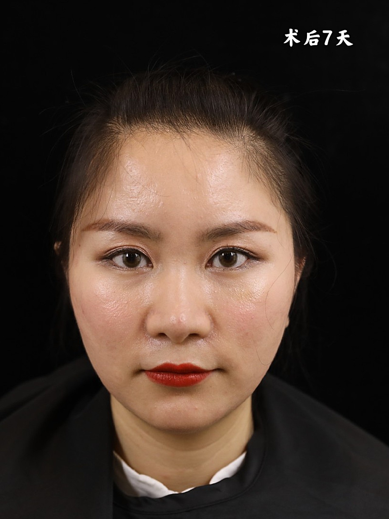 玻尿酸全脸填充,塑造精致饱满脸部!