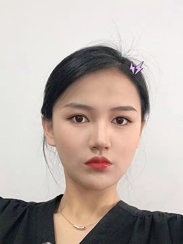 5mm的双眼皮来报道,因为眉眼间距偏近,所以医_圈子-新氧美容整形