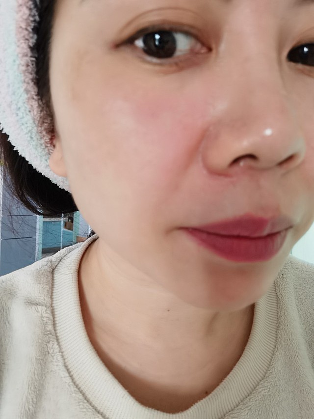 做的超皮秒掉结痂后这么多个月了黑色素沉淀特别多比以前没做的时候看
