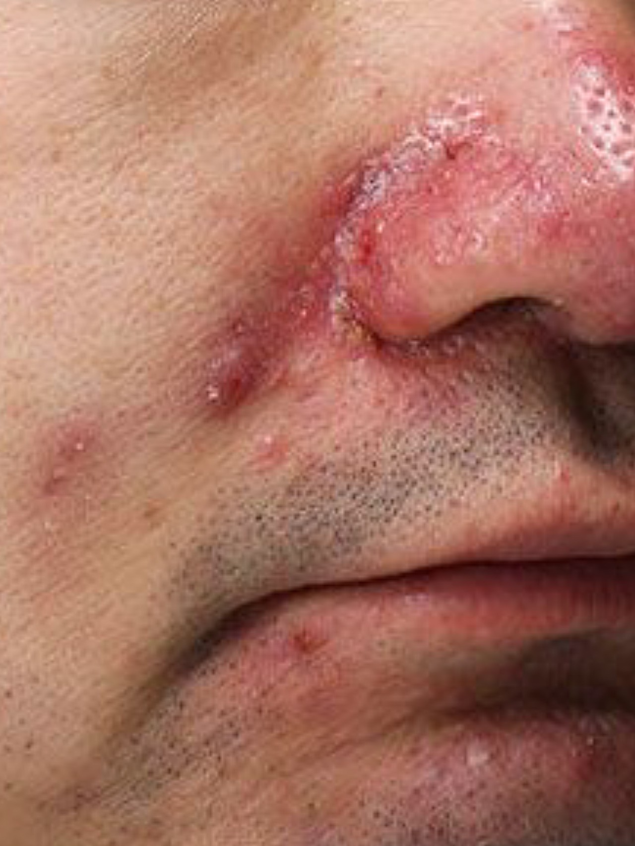 这位患者红斑痤疮 毛细血管扩张