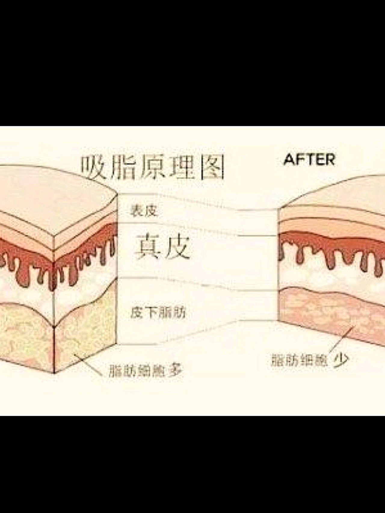 60抽脂肪对身体有害吗