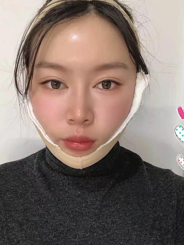 对于我做完这个面部吸脂手术的效果,还可以,不错的