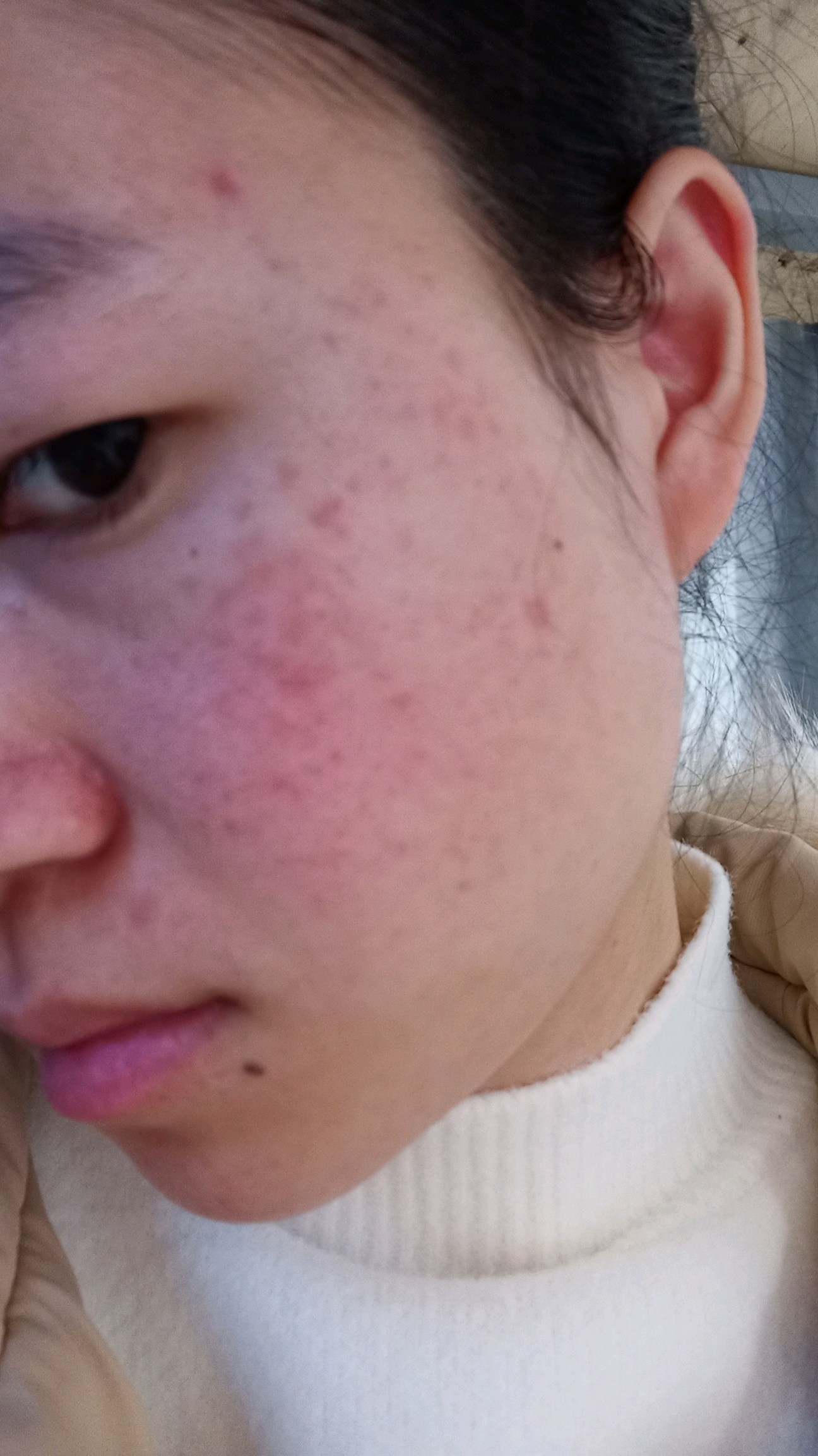 痘印两年了,脸颊有泛红,祛痘印做什么项目效果较好?