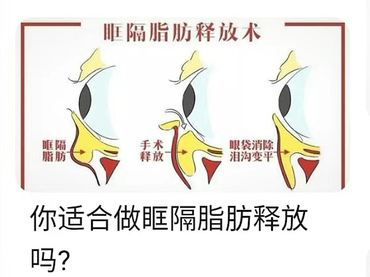 什么是眶隔释放祛眼袋?见图!