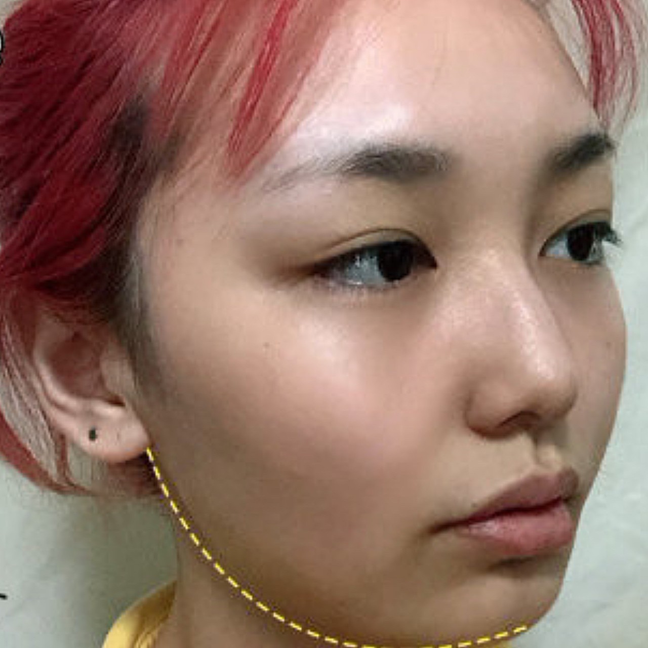 吸脂手术前:面部脂肪堆积明显,下颌缘线条不清晰,整个脸比较臃肿