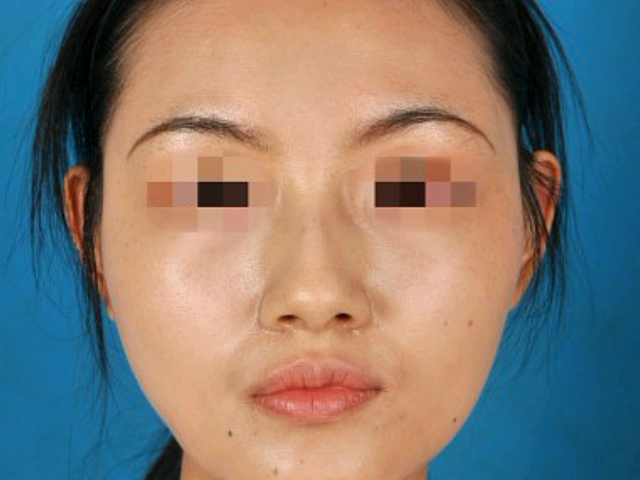 u型脸改善建议面部轮廓手术方案设计