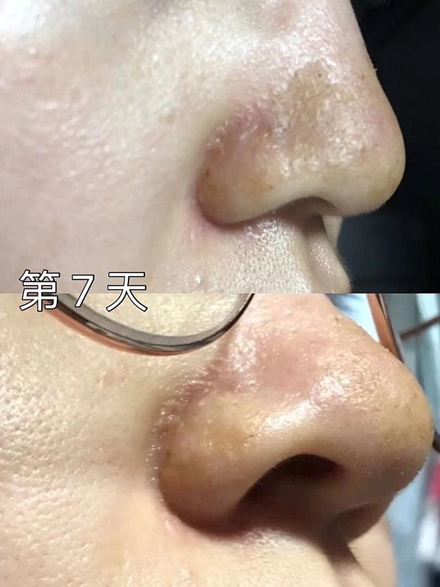 点阵激光去黑头记录