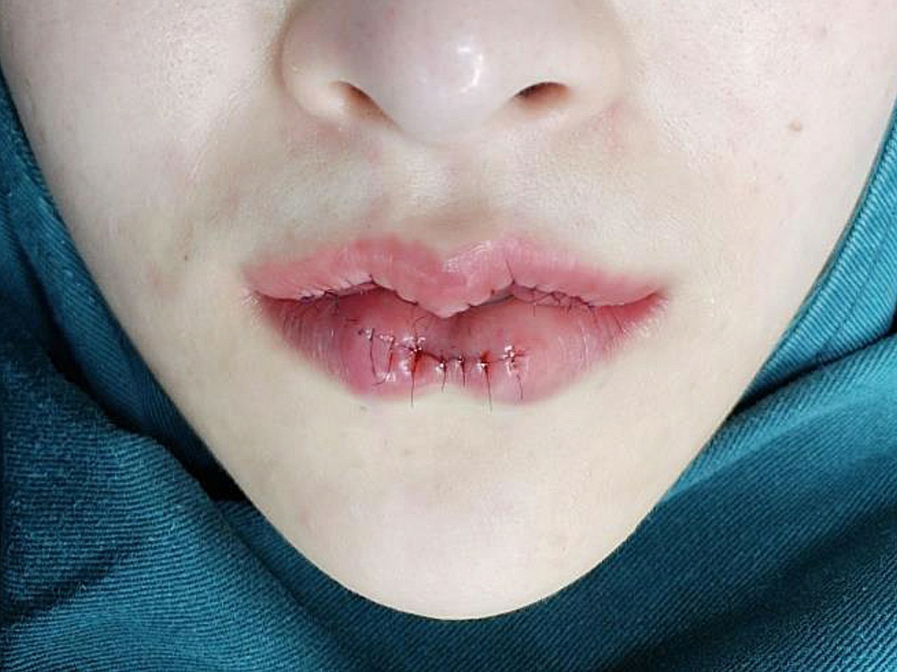 以前还没觉得自己的嘴巴这么丑,突然有一天刷到一个视_圈子-新氧美容