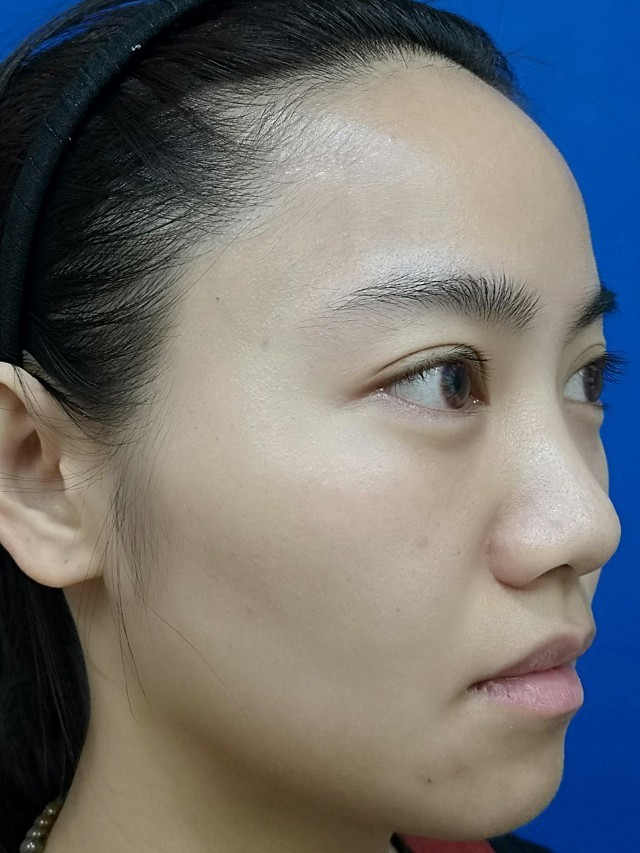 我是那种面部虽然不难看,但是五官不立体,面部有些凹_圈子-新氧美容