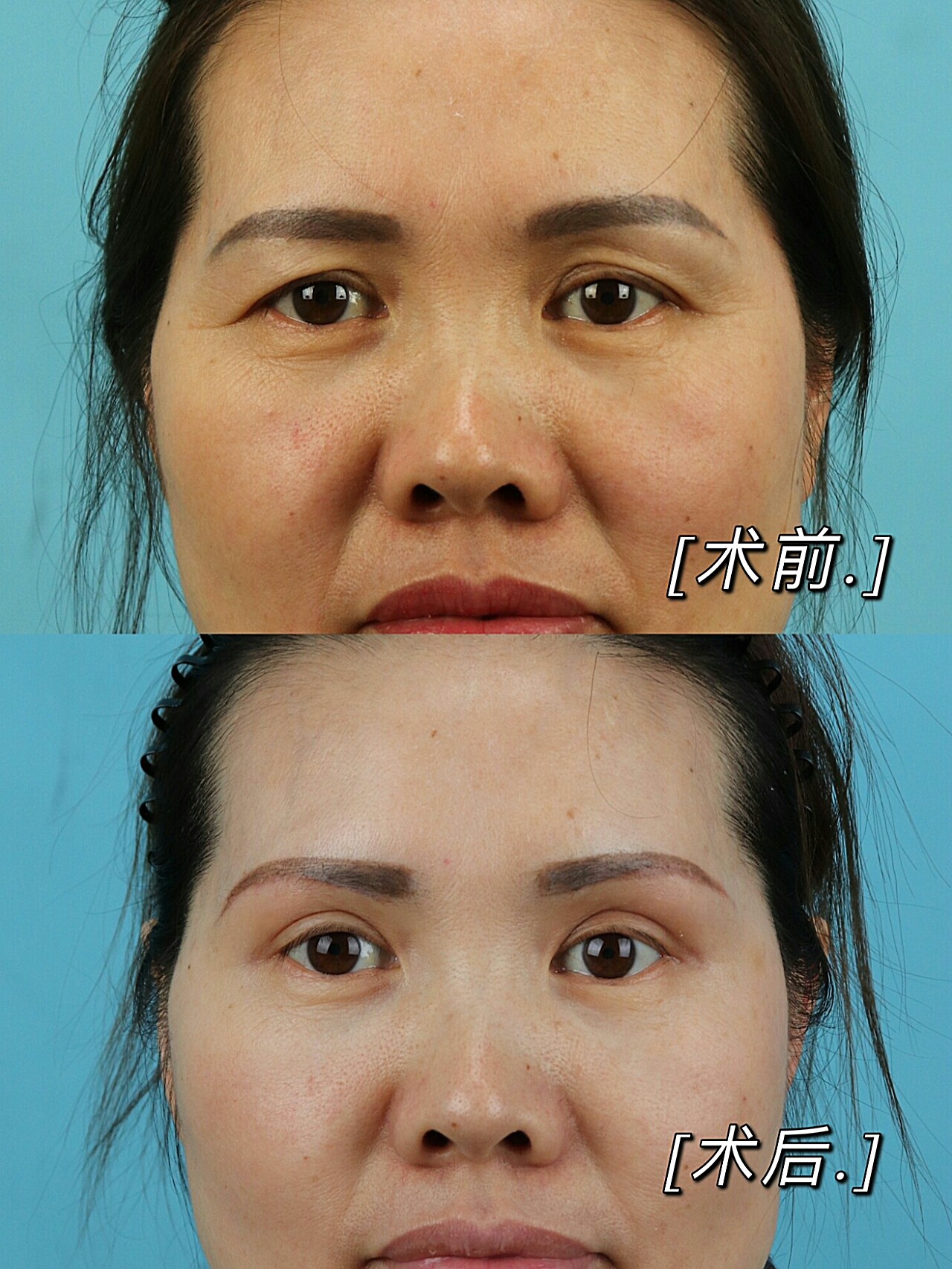 眼尾下垂,上睑皮肤松弛,眼皮赘皮明显