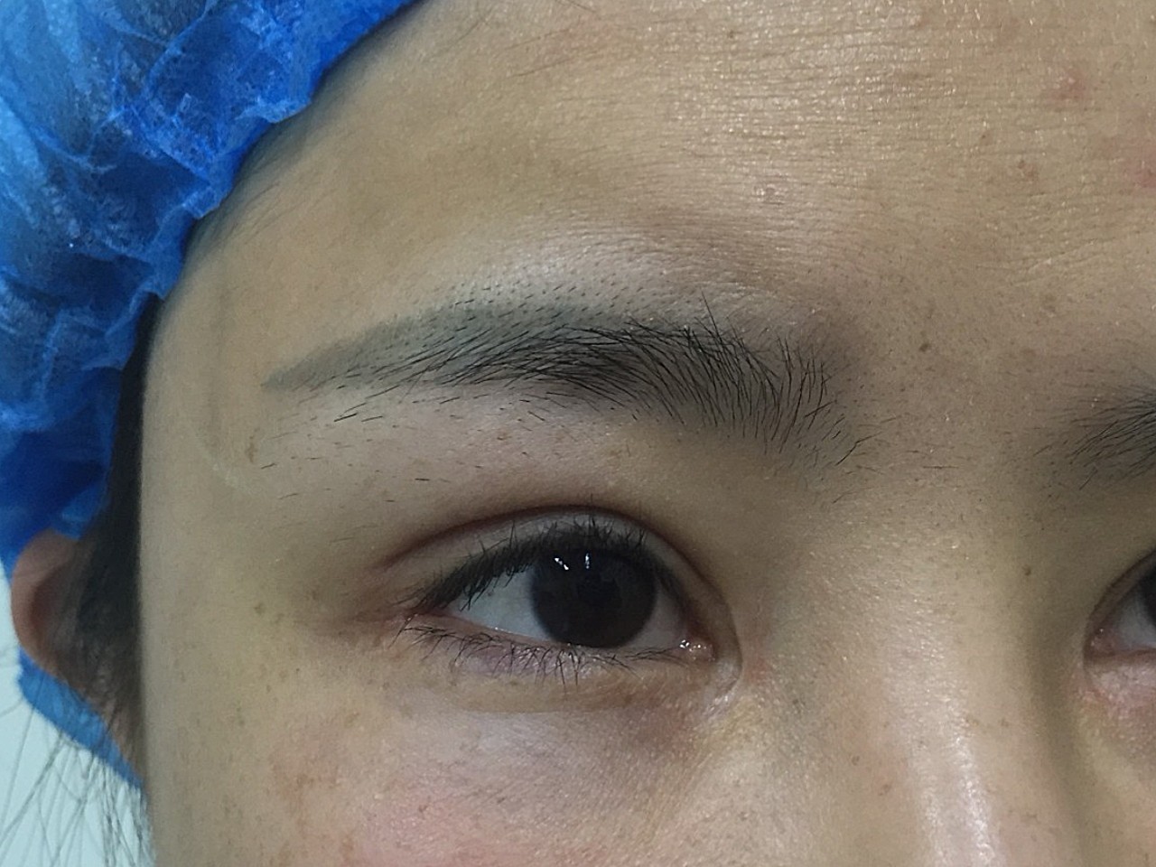 内眼角重建术后,打了疤痕针之后,包好的眼角因为打了