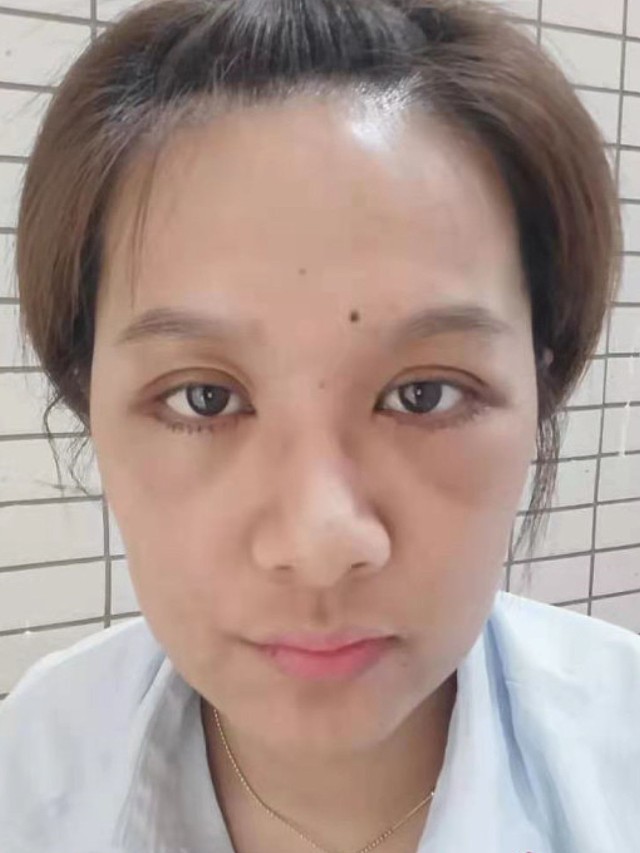 我的眼袋真的很严重了,而且也下垂