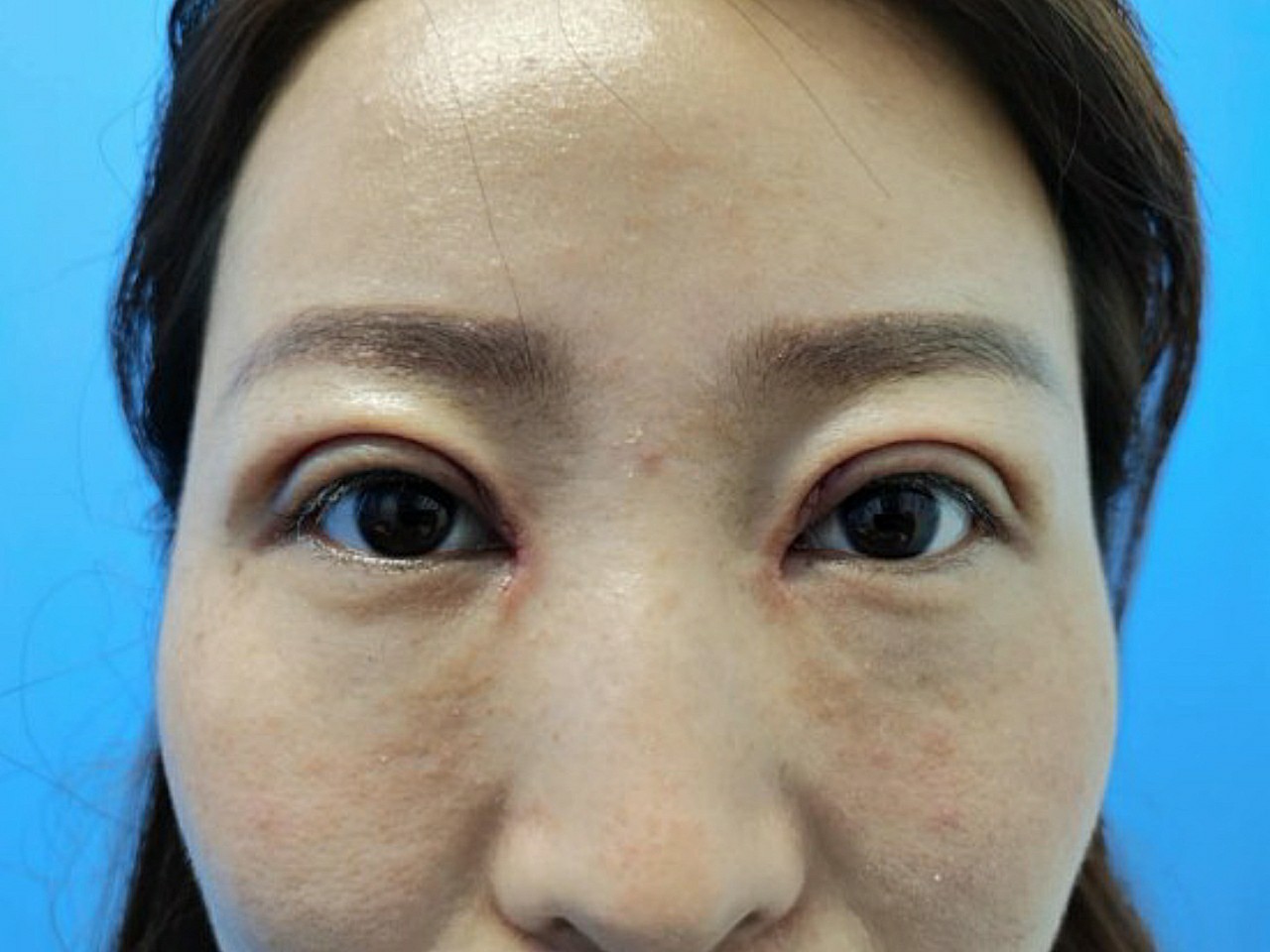 【切开重睑上睑提肌开内眼角】术后第7天-拆线日今_圈子-新氧美容整形