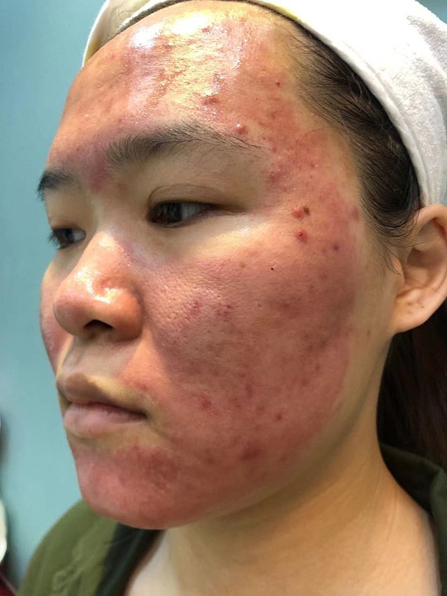 这是刚刚做完这个黄金微针后的样子.丝丽是后面做的.