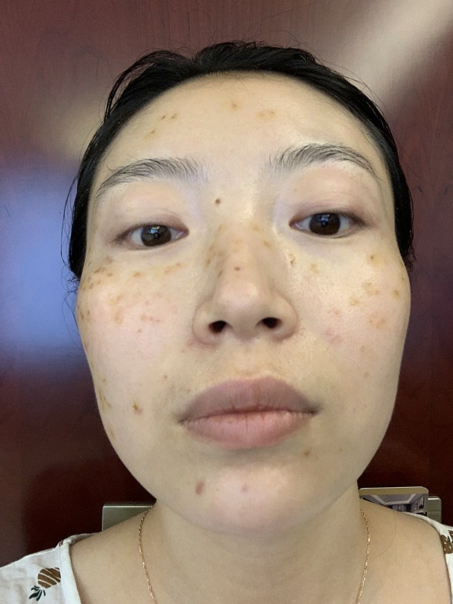 皮秒激光第一天.