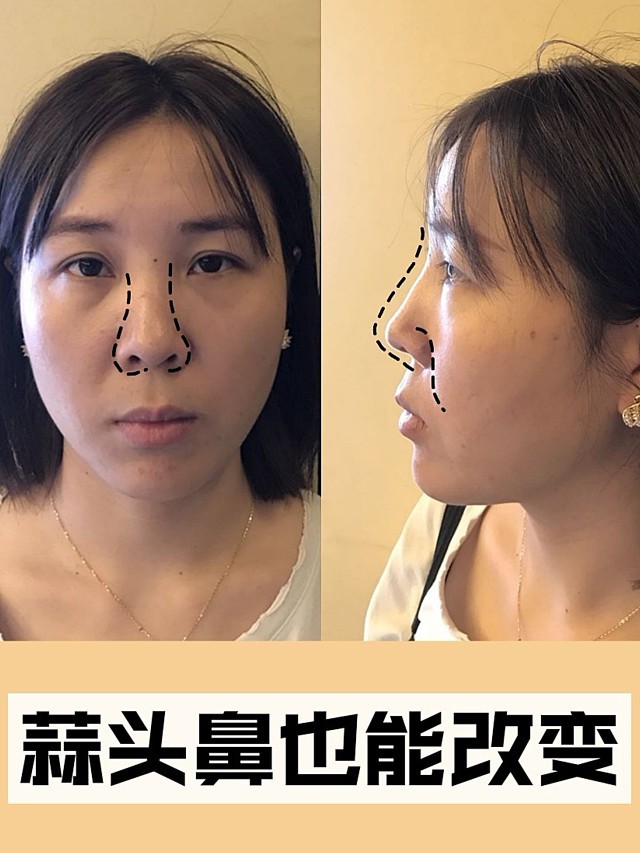 能改变7115我一直觉得我的鼻子是我的缺陷,所_圈子-新氧美容整形