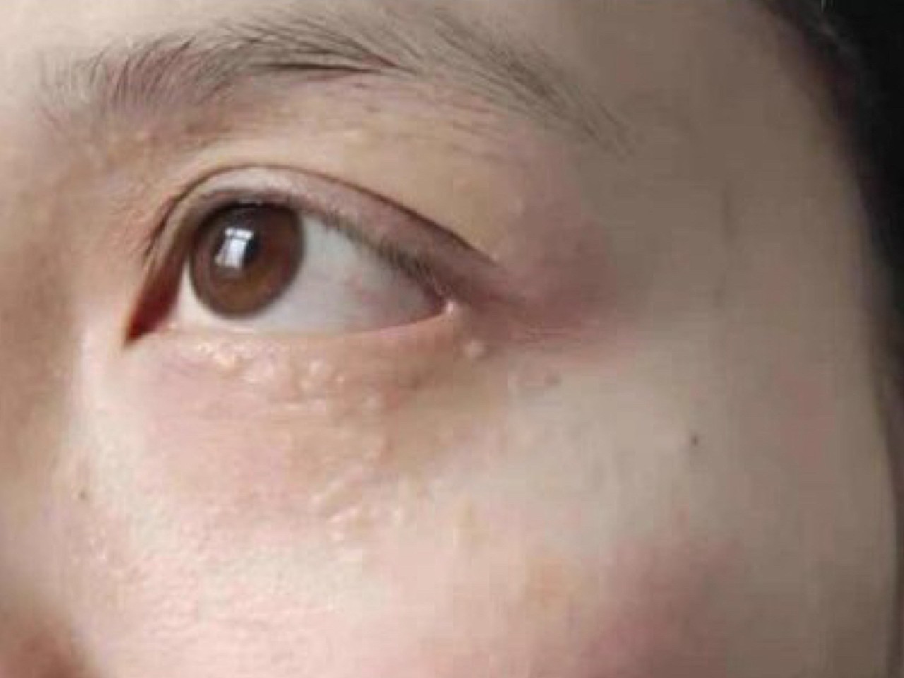 眼角的脂肪粒困扰了我两年多了,又大有显眼,经常被人_圈子-新氧美容