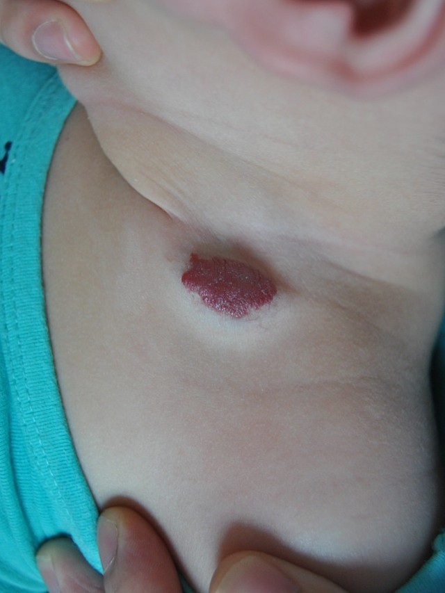 宝宝是颈部血管瘤,长在皱褶部位,1岁之前发展较快
