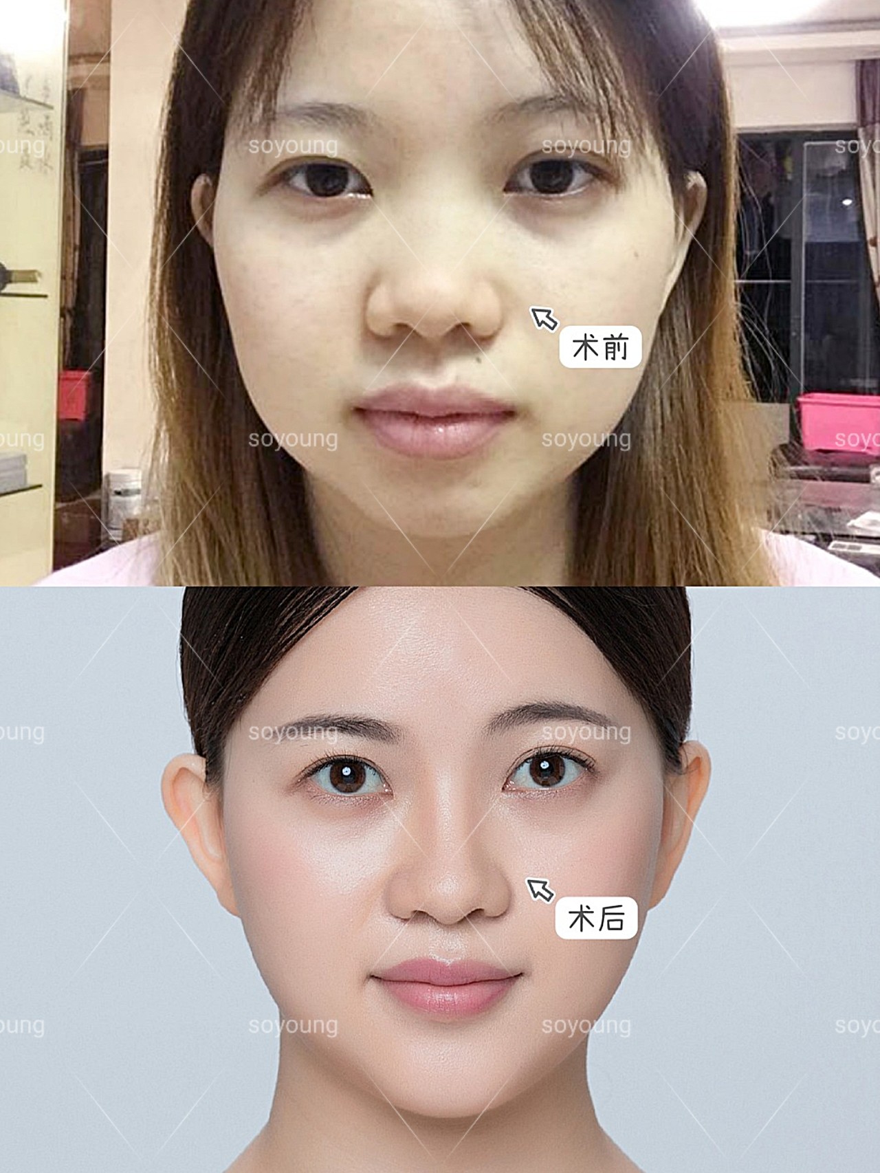 术前诊断蒜头鼻加短下巴的整形方案鼻子位于面部的正中_圈子-新氧美容