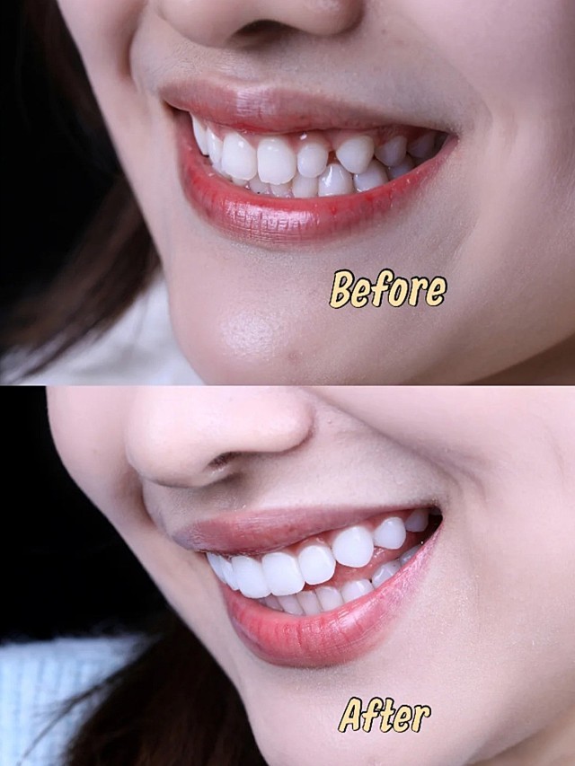 97患者情况:牙齿整齐度基础比较好,左右两边的3号_圈子-新氧美容