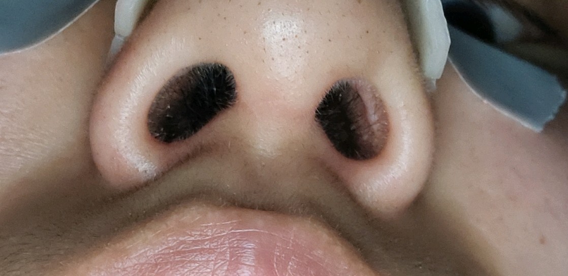 隆鼻鼻孔内增生图片图片
