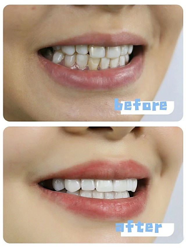 🎀树脂贴面换全瓷贴面的过程以及感受🎀-🌻患者的牙齿_圈子-新