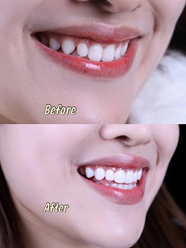 97患者情况:牙齿整齐度基础比较好,左右两边的3号_圈子-新氧美容