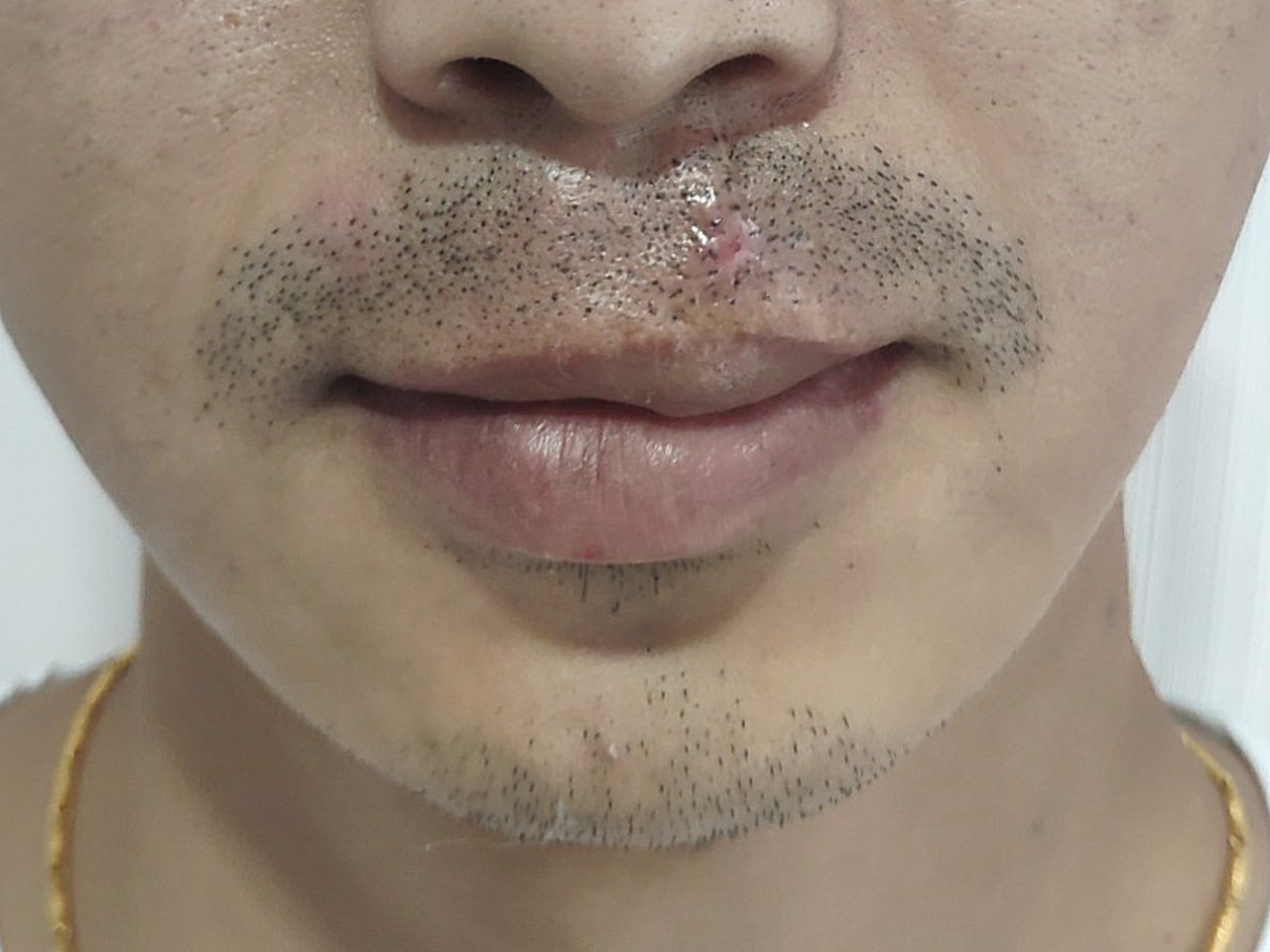 [:163]体验前变美诉求:我想纹胡须的主要目的是_圈子-新氧美容整形