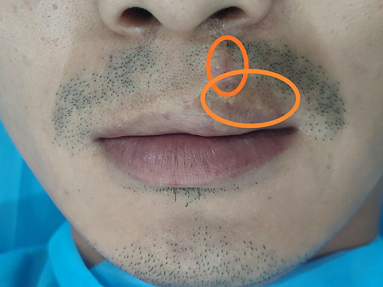 [:163]体验前变美诉求:我想纹胡须的主要目的是_圈子-新氧美容整形