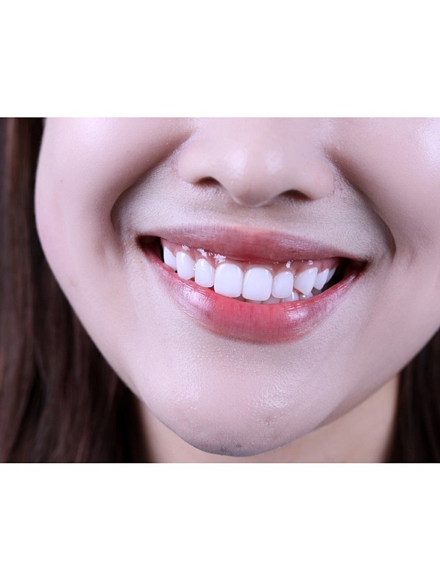 [:163]体验前变美诉求:侧牙过小间隙大微笑线不_圈子-新氧美容整形