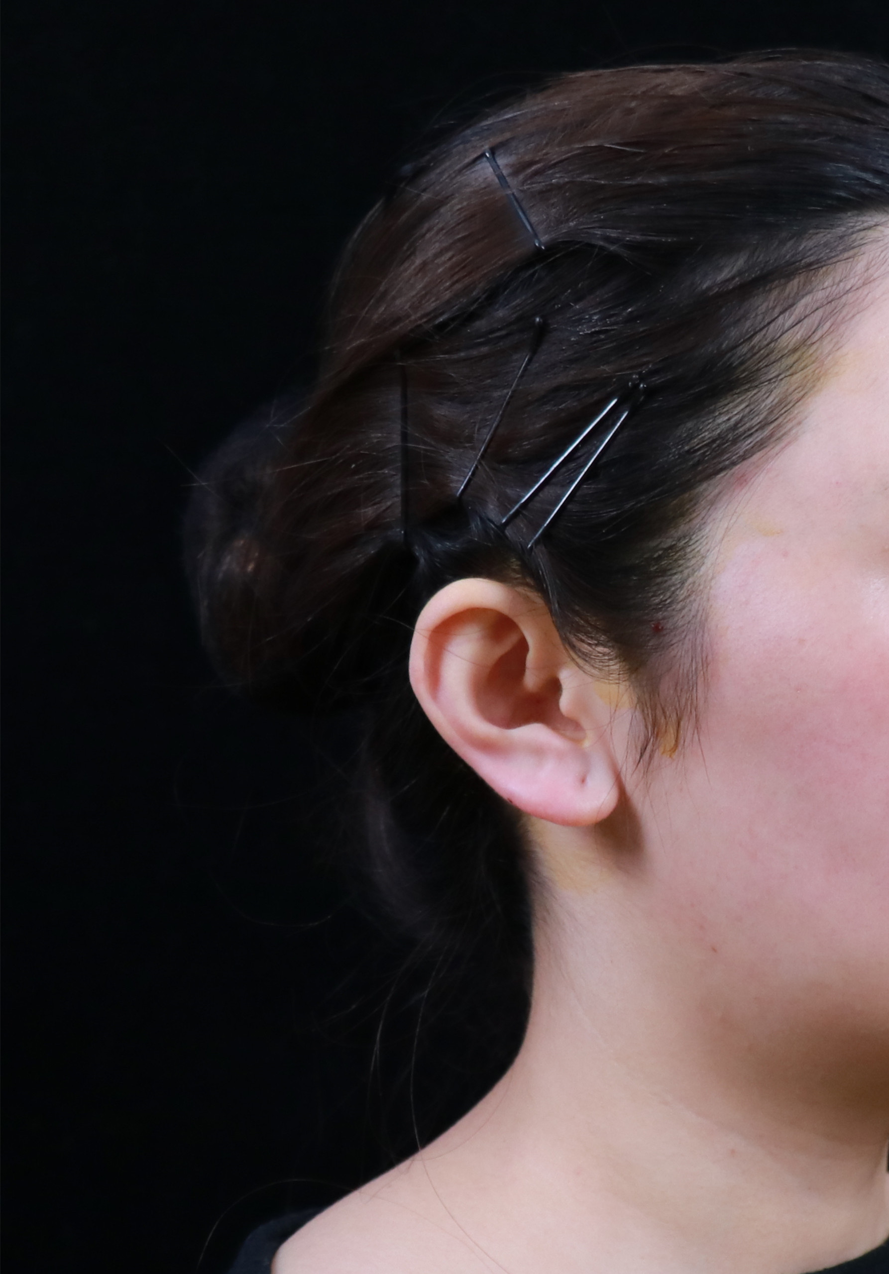 终于注射了精灵耳,一直都想注射来着,但是感觉注射精_圈子-新氧美容