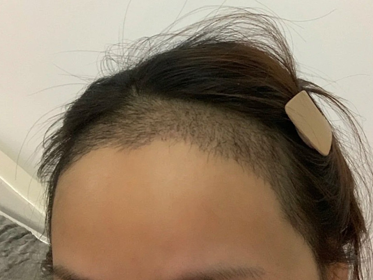 植发第20天大脑门女孩的头包脸逆袭之路