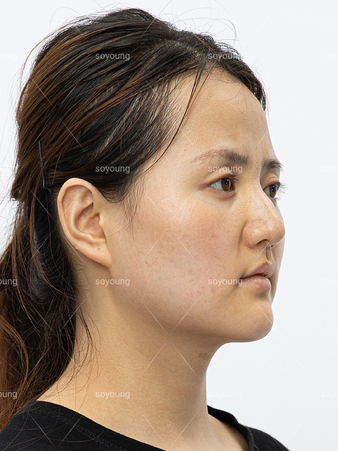 术前诊断鼻部基础较好.正面看,鼻子小巧,山根略低,_圈子-新氧美容整形