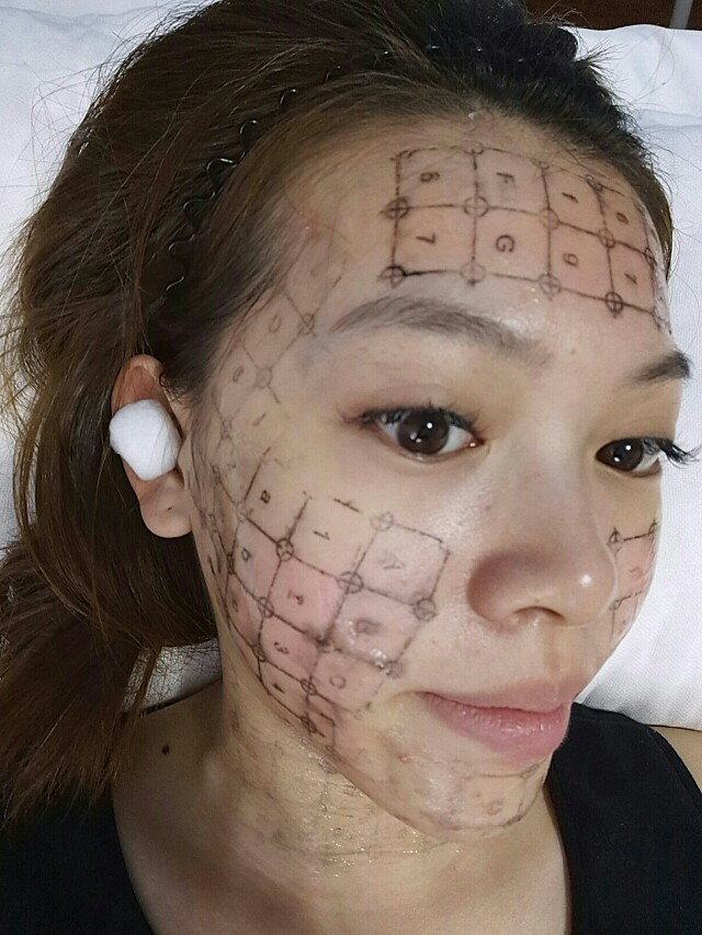 第1天.做完热玛吉眼部450发第1天,眼部还是_圈子-新氧美容整形