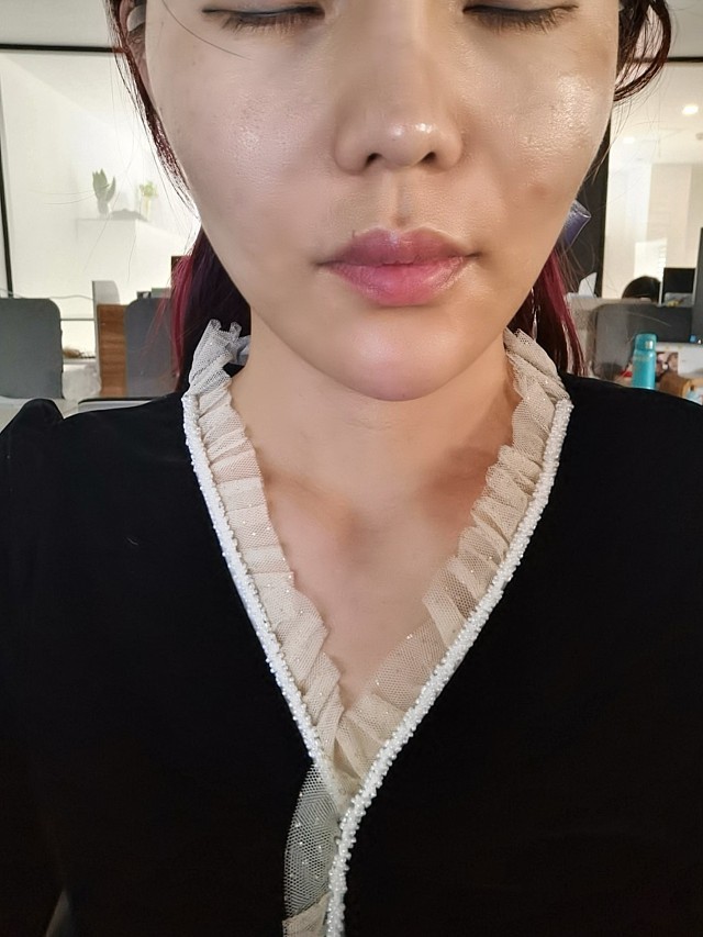 中下面部线雕第三天,脸疼而且肿得也挺厉害.