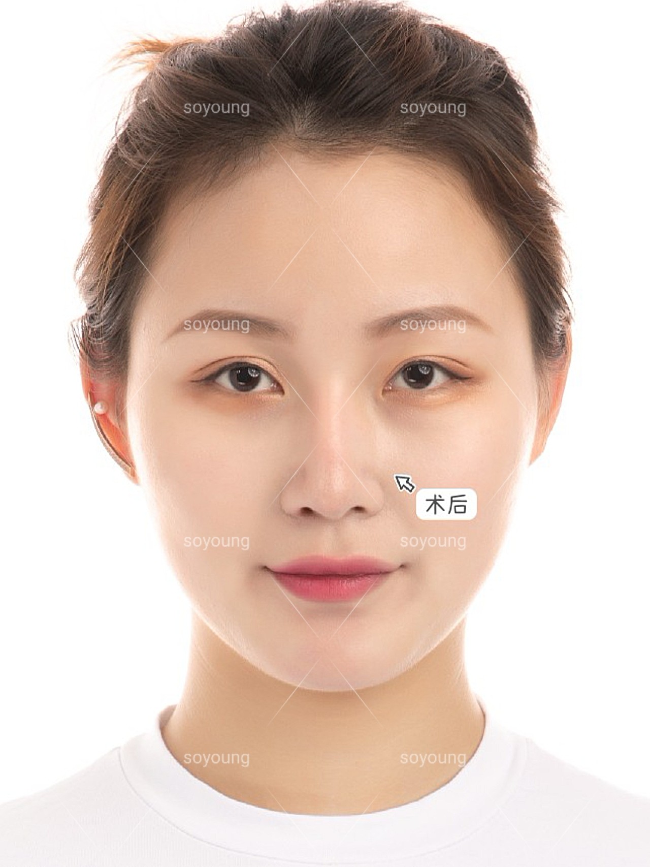 术前诊断缺少山根,鼻梁低平,鼻翼宽大,属于亚洲人中_圈子-新氧美容
