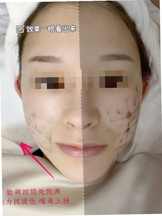 做完热玛吉第四天,脸上已经消肿了,之前刚做完时的疼_圈子-新氧美容