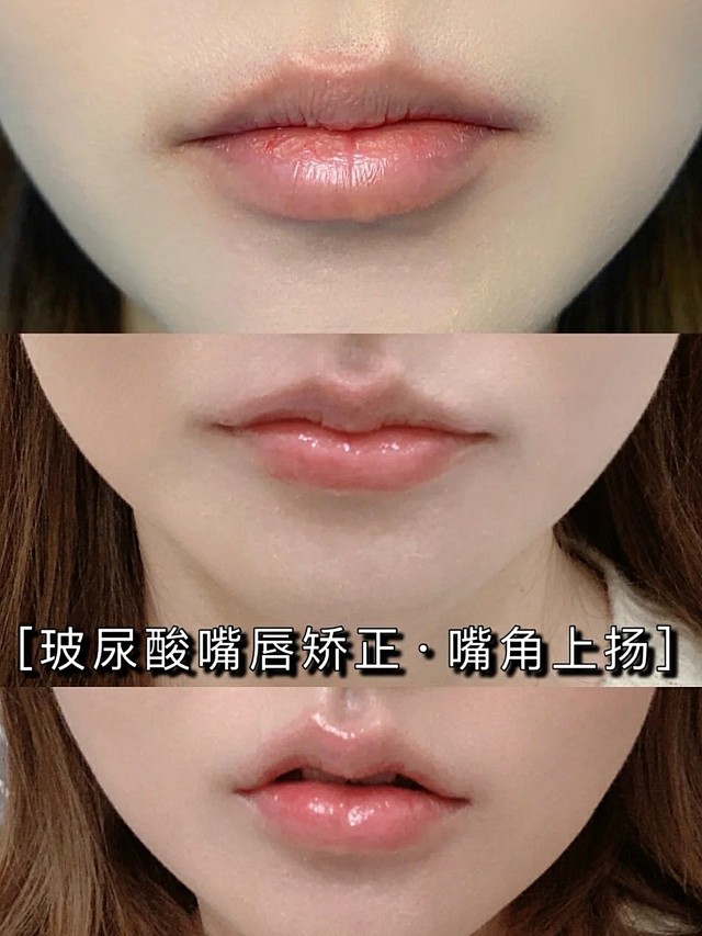 因为我一直就对自己耷拉的平嘴角比较在意不笑的时候看起来会比较严肃