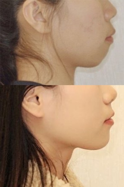 你可能不是胖,也许只是嘴凸而已.我是95后,光看脸_圈子-新氧美容整形