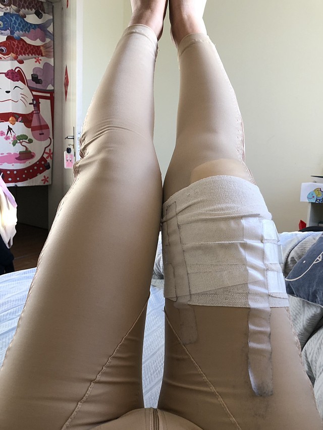 思美诺大腿吸脂第7天-水动力环吸