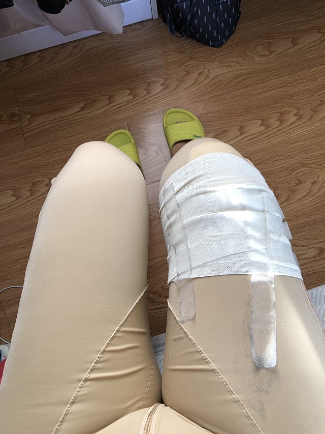 思美诺大腿吸脂第7天-水动力环吸