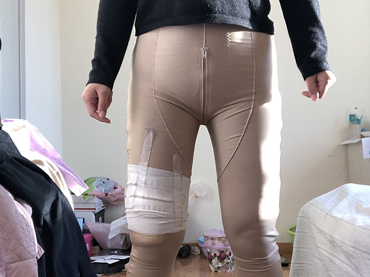 思美诺大腿吸脂第3天-水动力环吸