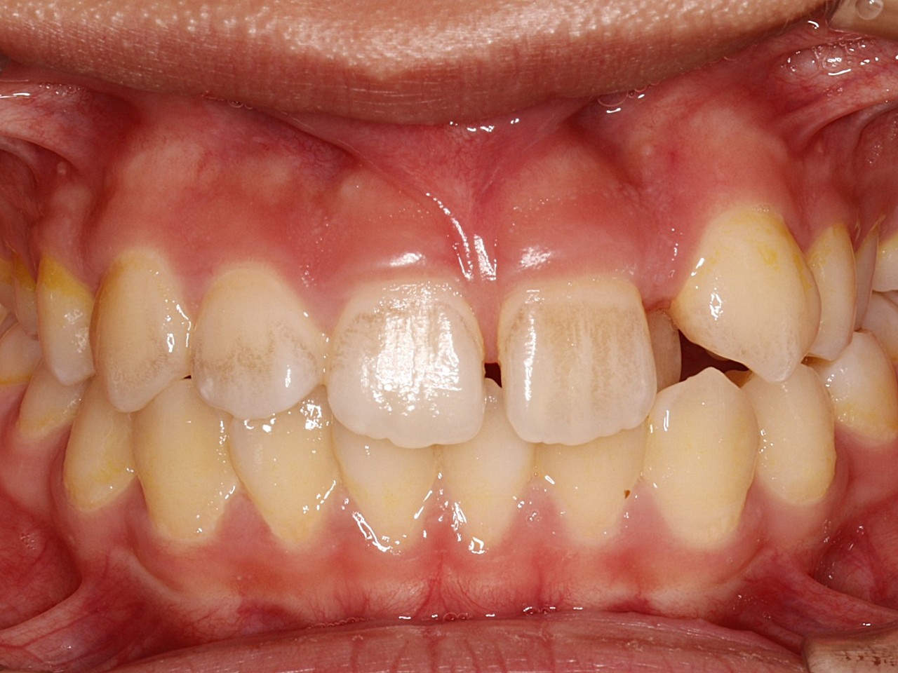 成年人的牙齿矫正案例