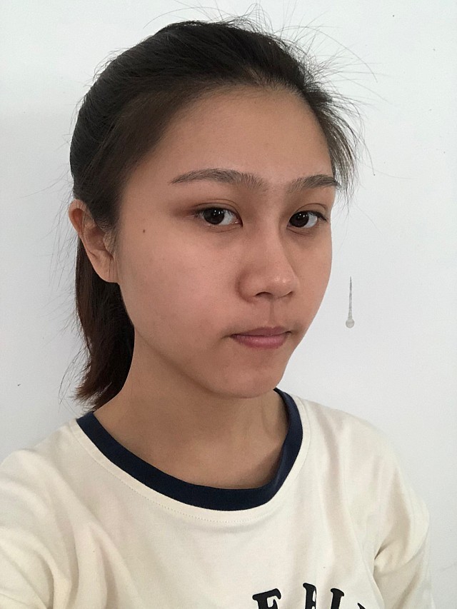 【术前诊断】:鼻头圆钝,山根比较塌陷【方案设计】:_圈子-新氧美容