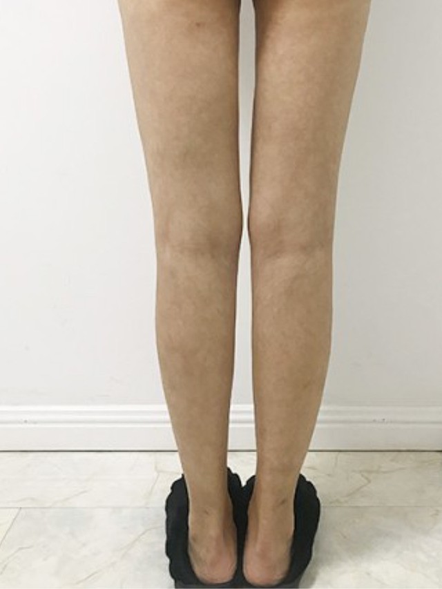 腿太粗了,走路的时候大腿内侧摩擦,影响走路姿势.