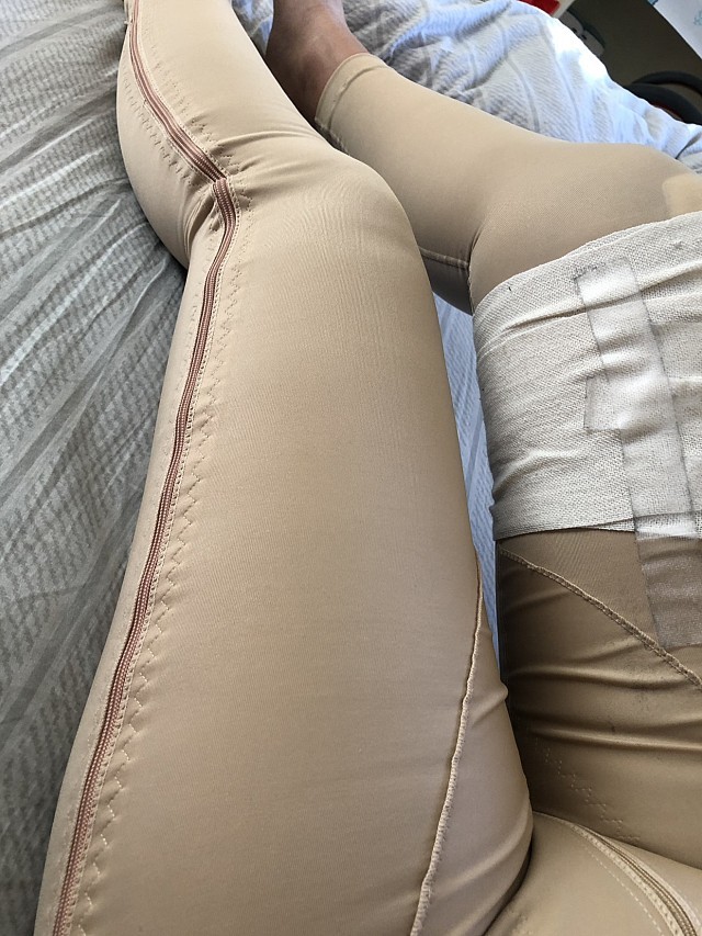 思美诺大腿吸脂第15天-水动力环吸