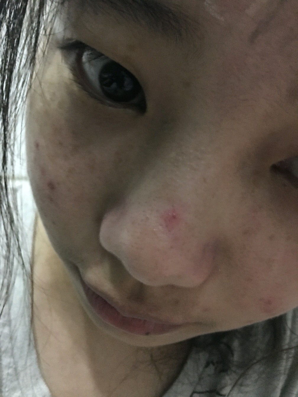 鼻子前的红点怎么去掉