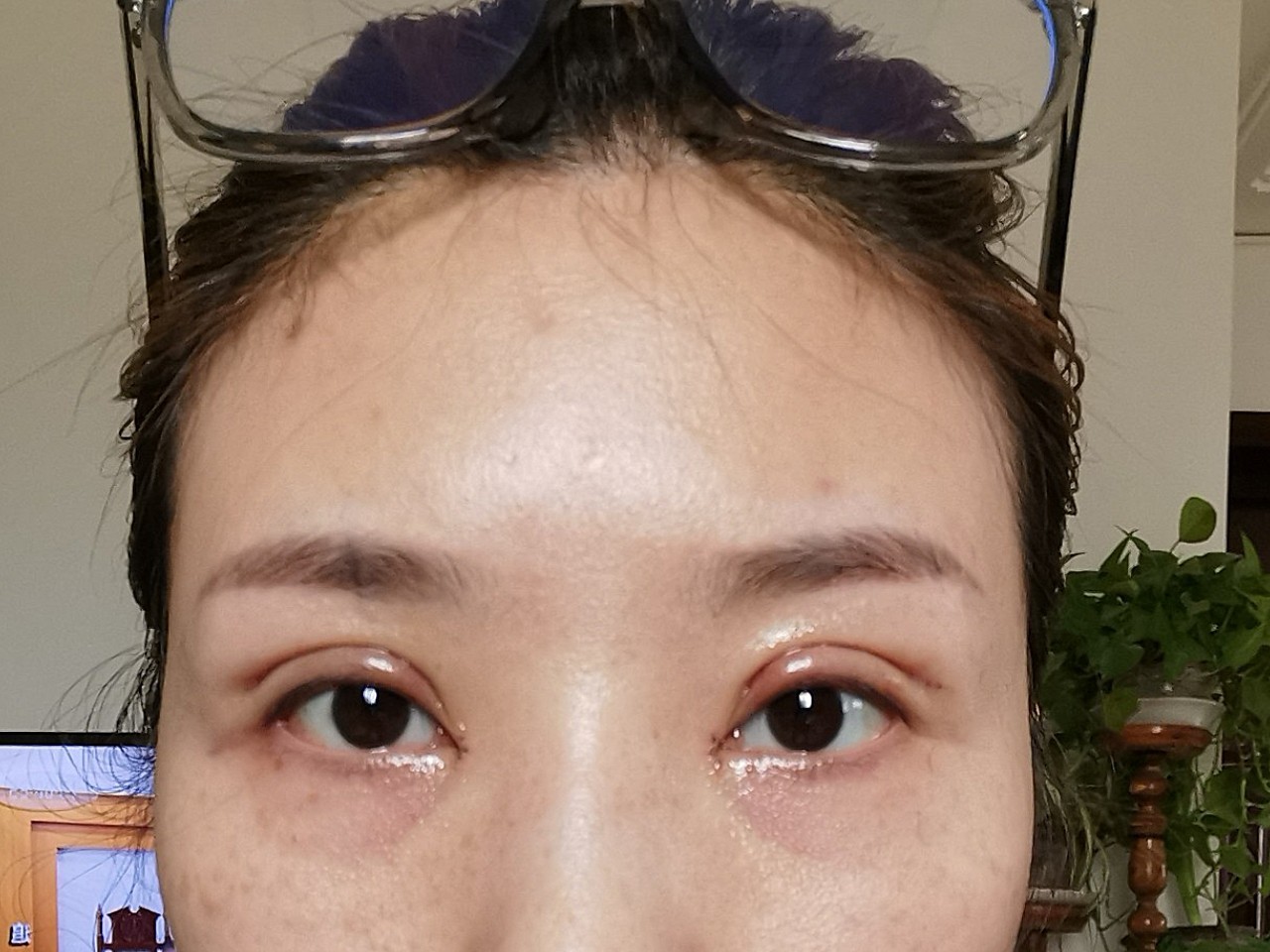 全切双眼皮第四天是不是失败了0101