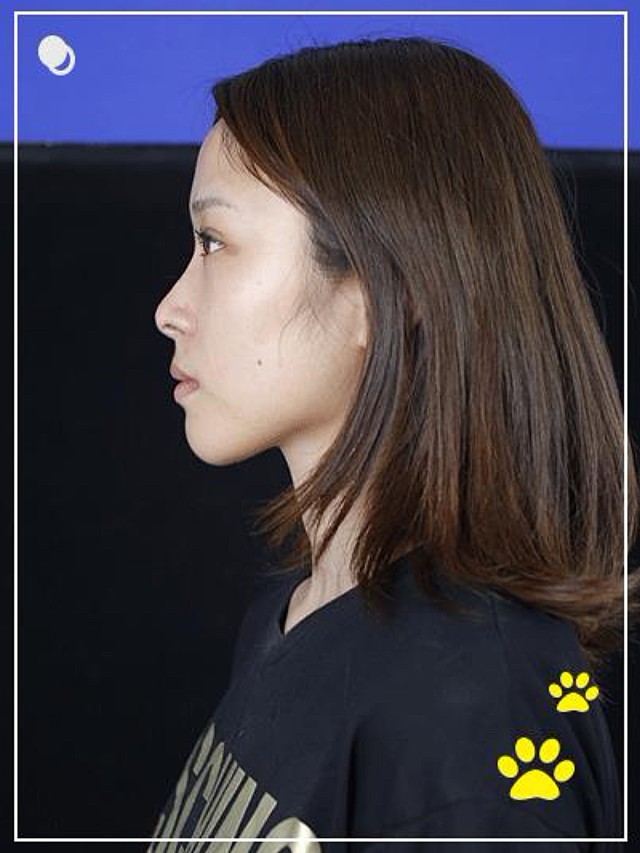 最不喜欢自己的鼻子了,没有山根,鼻子塌塌的,天天就_圈子-新氧美容