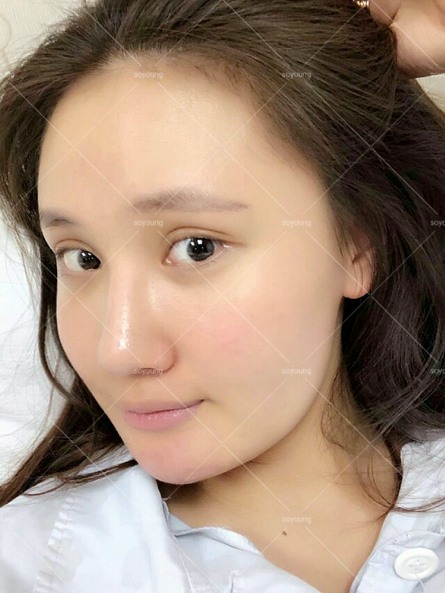 颧骨颧弓整形术四级资质颧骨颧弓整形3d颧骨颧弓定制整形